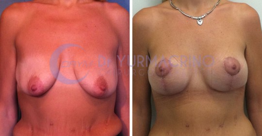 Mastopexy with Implants – Case 24/A