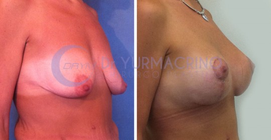 Mastopexy with Implants – Case 24/B