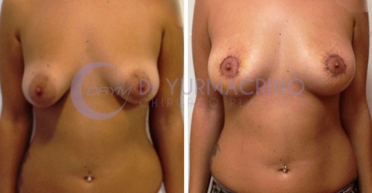 Mastopexy Round-Block – Case 4/A