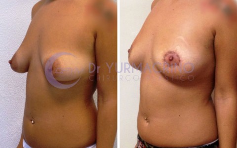 Mastopexy Round-Block – Case 4/B