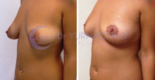 Mastopexy Round-Block – Case 4/B