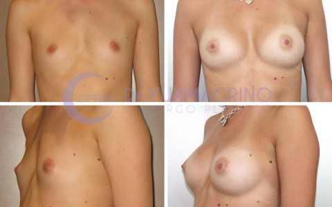 Breast Augmentation – Case 27