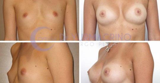 Breast Augmentation – Case 27