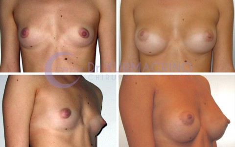 Breast Augmentation – Case 28