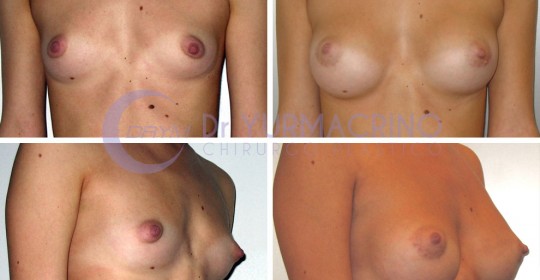 Breast Augmentation – Case 28