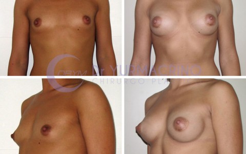 Breast Augmentation – Case 29