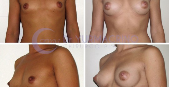 Breast Augmentation – Case 29