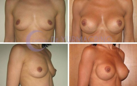 Breast Augmentation – Case 30
