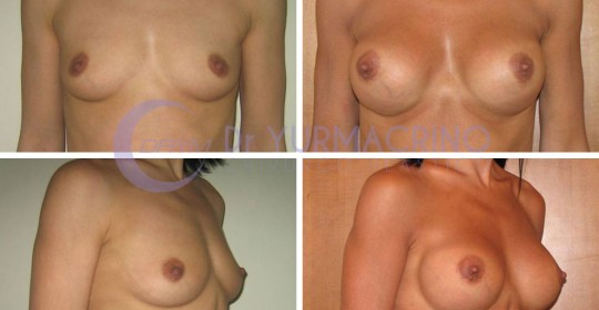 Breast Augmentation – Case 30