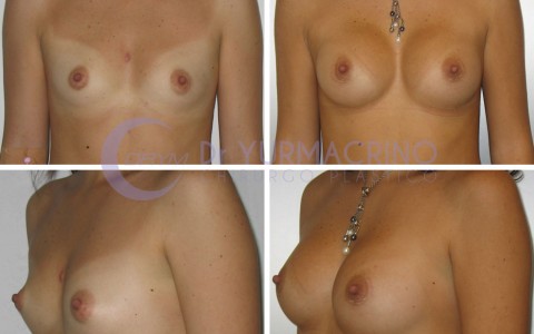 Breast Augmentation – Case 31