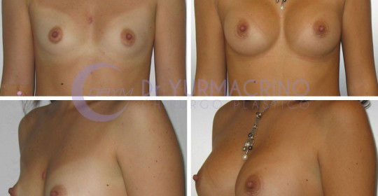 Breast Augmentation – Case 31