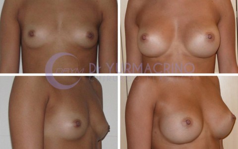 Breast Augmentation – Case 32