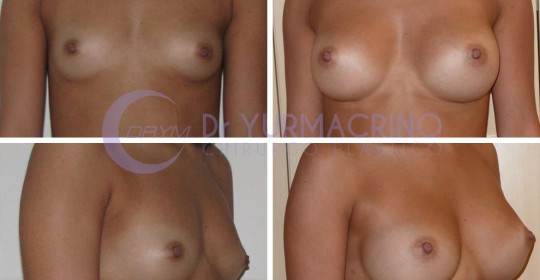 Breast Augmentation – Case 32