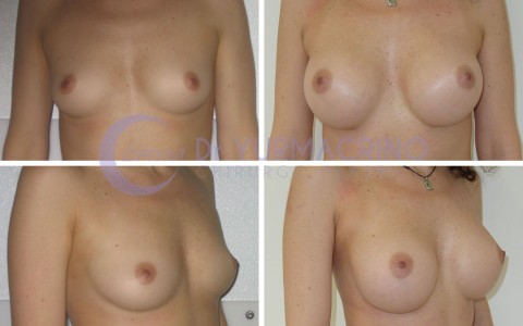 Breast Augmentation – Case 33