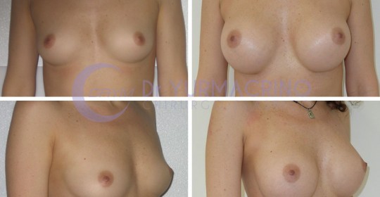 Breast Augmentation – Case 33