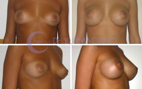 Breast Augmentation – Case 34