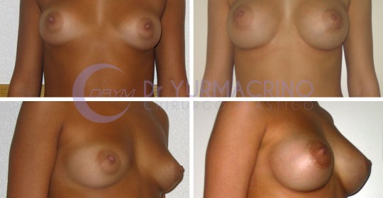 Breast Augmentation – Case 34