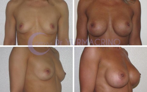 Breast Augmentation – Case 35