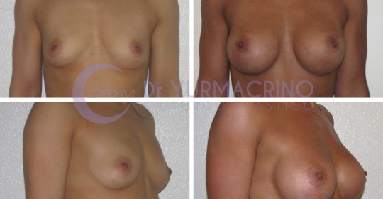 Breast Augmentation – Case 35