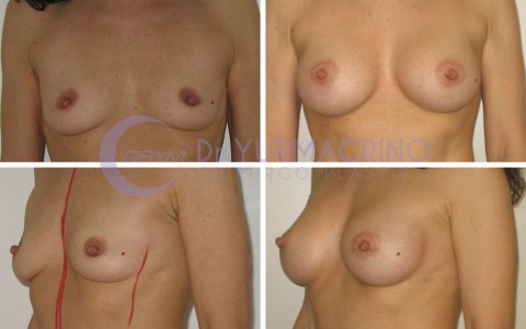 Breast Augmentation – Case 36