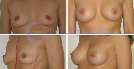 Breast Augmentation – Case 36