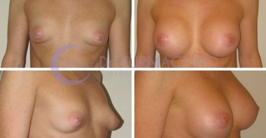 Breast Shape Correction – Case 13
