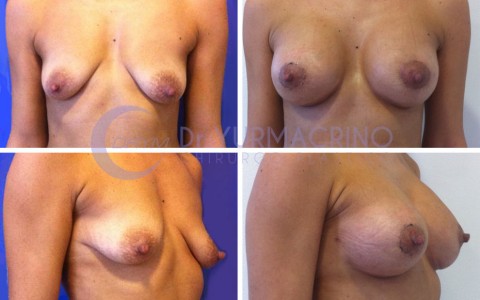 Breast Shape Correction – Case 14