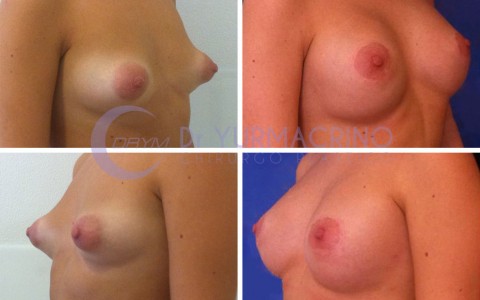 Breast Shape Correction – Case 15