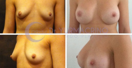 Breast Shape Correction – Case 16