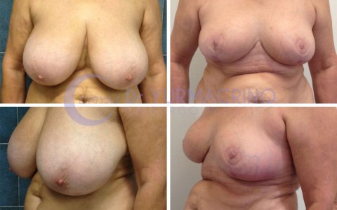 Breast Reduction – Case 1