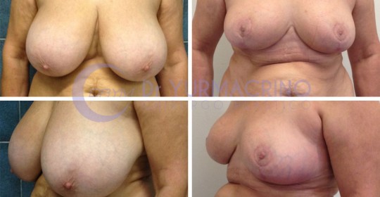 Breast Reduction – Case 1