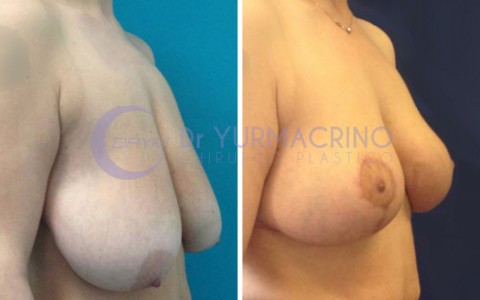 Breast Reduction – Case 2/A