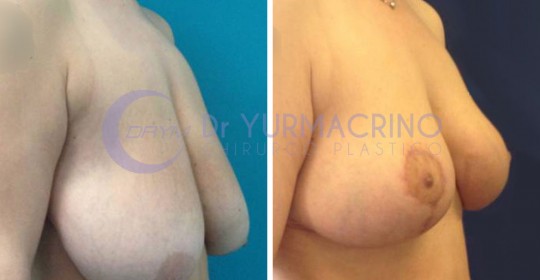 Breast Reduction – Case 2/A