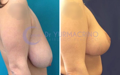 Breast Reduction – Case 2/B