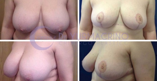 Breast Reduction – Case 4