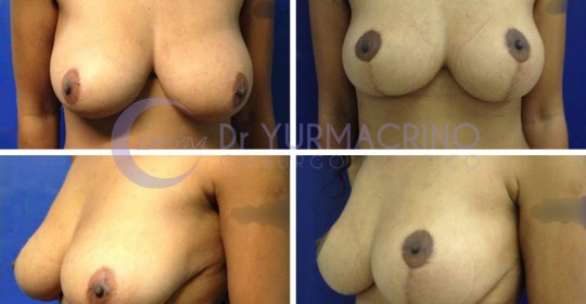 Breast Reduction – Case 5