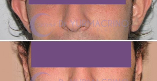 Otoplasty – Case 3