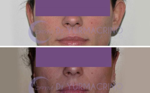 Otoplasty – Case 7