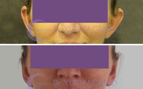 Otoplasty – Case 8