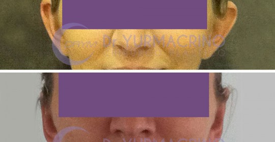 Otoplasty – Case 8