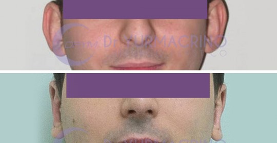 Otoplasty – Case 9