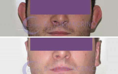 Otoplasty – Case 11