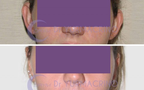 Otoplasty – Case 12