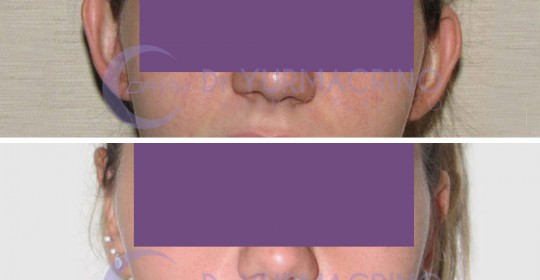 Otoplasty – Case 12