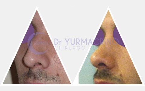 Men Rhinoplasty – Case 1/A