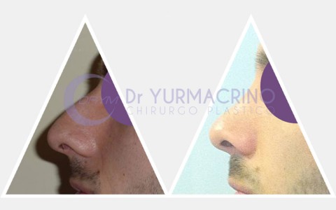 Men Rhinoplasty – Case 1/B