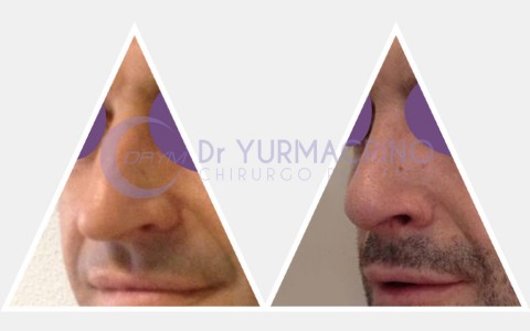 Men Rhinoplasty – Case 2/A