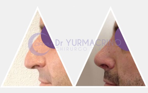 Men Rhinoplasty – Case 2/B