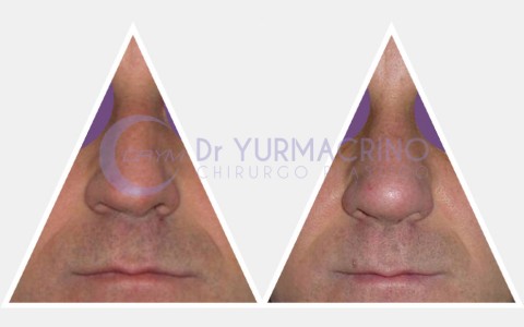 Men Rhinoplasty – Case 3/A