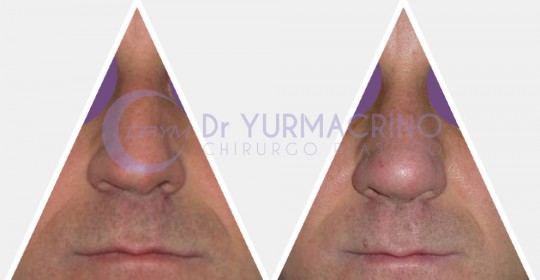 Men Rhinoplasty – Case 3/A